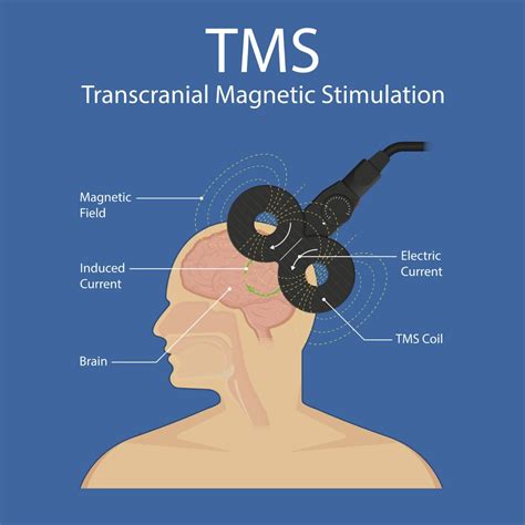 Tms therapy in bellevue  LOCATIONS