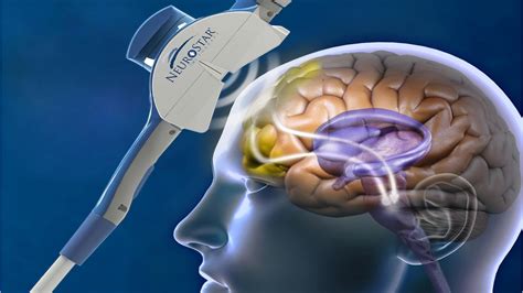 Tms treatment centers in seattle The latest Tweets from NeuroStim TMS Centers (@NeuroStimTMS)