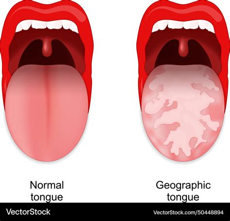 Tongitis  Brushing the teeth twice and daily flossing of the teeth helps in improving the health of tongue