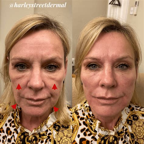 Treatment for marionette lines sandton Restylane Fillers are available at Skin Renewal in Cape Town, Stellenbosch, Paarl, Sandton, Johannesburg, Pretoria, Centurion, Durban, Umhlanga & Ballito