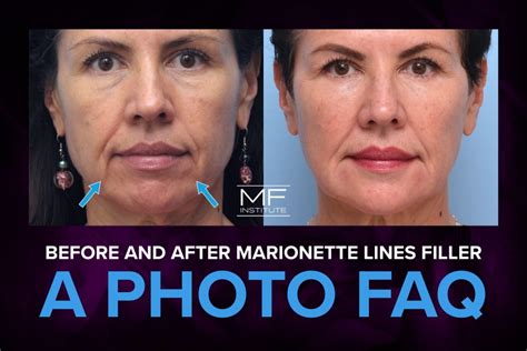 Treatment for marionette lines sandton Answer: Juvederm in marionette lines