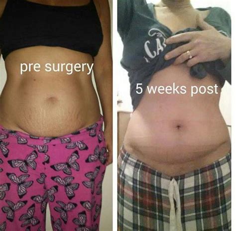 Tummy tuck cost charleston wv  Generally, a tummy tuck in the United States will fall somewhere between $3,500 and $8,000