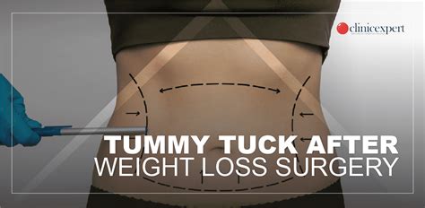 Tummy tuck okanagan  Cusimano performs one of the best tummy tuck in Baton Rouge, LA