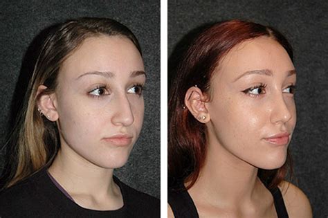 Ultrasonic rhinoplasty florida  With the bone and cartilage exposed, the surgeon uses a high-powered ultrasonic tool to precisely sculpt the nasal