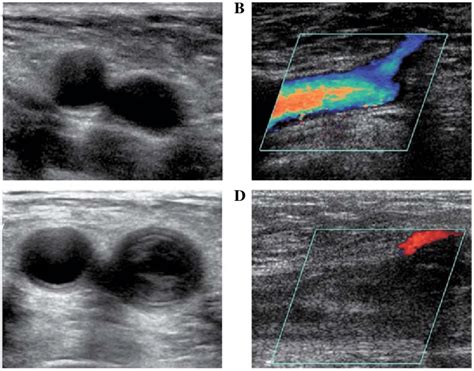 Ultrasound direct , ultrasound color flow imaging of the carotid artery) is an example of a non-invasive sensor
