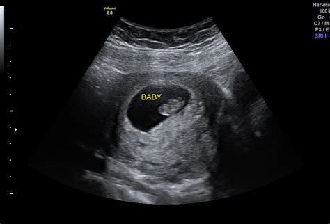 Ultrasound pregnancy near me  Your 4D Baby 3D 4D HD and 5D Ultrasound Centre offer low cost Gender Reveal Sonograms and an affordable sonograms in Miami and nearby areas