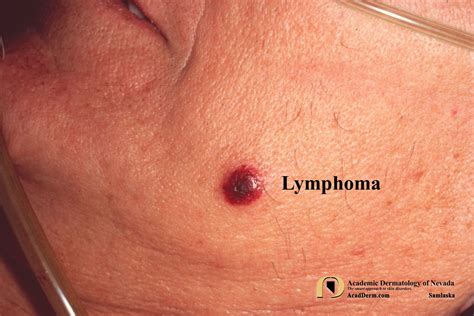 Pukulomadda - Vaginal b cell lymphoma Gay free nude pictures