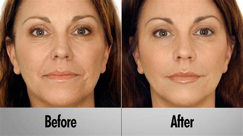 Vampire facelift hartford  In addition, no incisions are made in the process, making recovery much faster