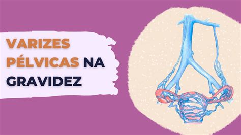 Varizes pélvicas incha a barriga  A cavidade pélvica feminina contém o trato reprodutivo feminino superior (colo do útero, útero, ovários, tubas uterinas); os anexos se referem aos ovários, tubas uterinas e tecidos conjuntivos circundantes