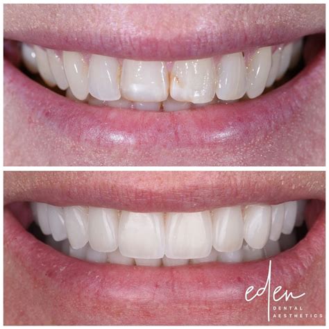 Veneers in encinitas  Call us today on (760)283-6733 for free estimates