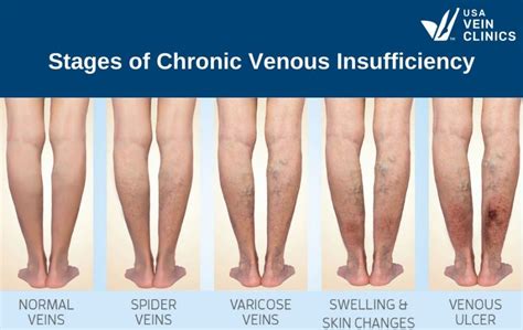 Venous insufficiency icd 10 code Conservative management for chronic venous insufficiency (Noninvasive procedures)