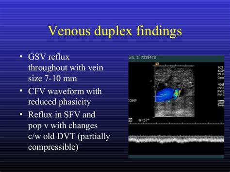 Venous reflux icd 10  10 11 Another important outcome is patient-reported outcome measurements, which measures patients’ perspective in both