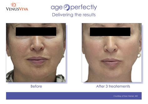 Venusvivo Venus Viva™ Skin Resurfacing Treatments; Book Now; Testimonials; Contact; Holiday Gift Cards Order Form – For Pickup at One of Our Clinics