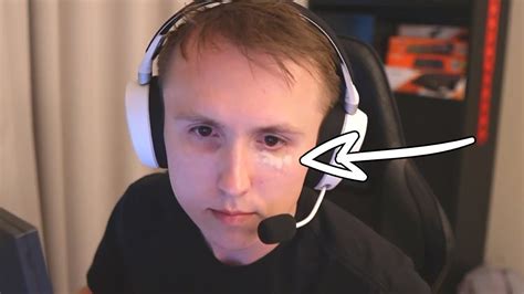 What does ropz have under his eye  About of ropz