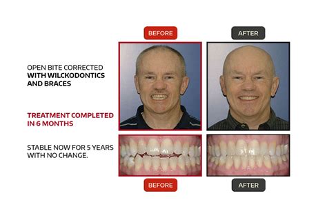 Wilckodontics cost  Suite 100