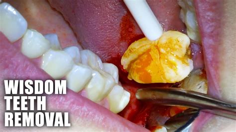 Wisdom teeth removal marylebone  Dr