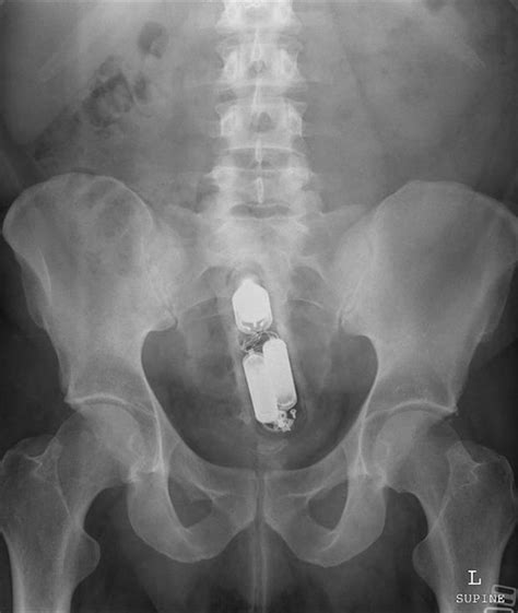 X ray candid ass  3 Comments