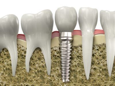 Yuba city dental implants cost  24