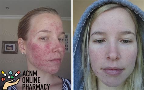 acutante Low-dose or microdosed Accutane is an off-label use of isotretinoin (Accutane is just one of many brand names), by which patients take a smaller amount over a longer period of time