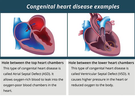 adult congenital heart disease near riverbank There have been many recent advances in treatments and care
