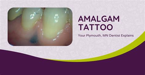 amalgam tattoo photos  A 49-year-old woman without a personal or family history of melanoma presented with an