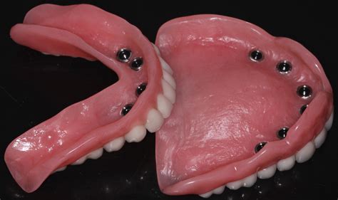 anchored dentures encinitas  It takes time, oral surgery, and