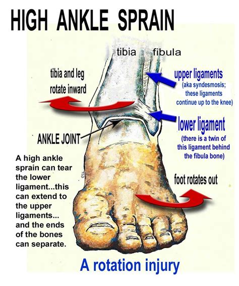 ankle injuryy lawyer  Should you have been involved in an accident at work and you suffered a severe ankle injury, it could mean you are unable to work for many months