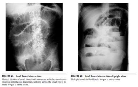 apa itu peritonitis  DEFINISI CAPD CAPD (Continuous Ambulatory Peritoneal Dialysis) adalah metode pencucian darah dengan menggunakan peritoneum (selaput yang melapisi perut dan pembungkus organ perut)