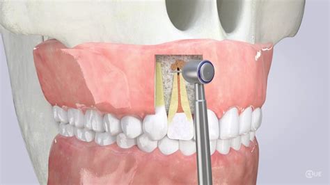 apicoectomy dental surgery specialists roseville ca An apicoectomy is an endodontic surgery