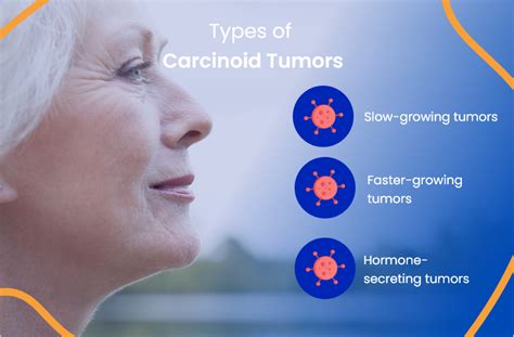 arconoid  These symptoms can sometimes go on for years before the carcinoid tumor is found