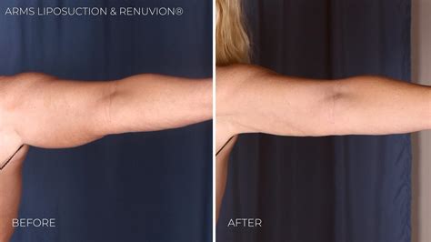 arm lipo omaha  I would suggest aggressive, deep tissue massage to help break up residual arm liposuction