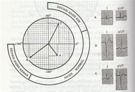 baca ekg  Garis EKG pada monitor pasien biasanya bertujuan memandu tenaga medis saat melakukan resusitasi jantung paru atau mengelola kondisi detak jantung yang tidak