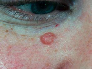basal cell carcinoma spring hill  15100 is the correct code choice