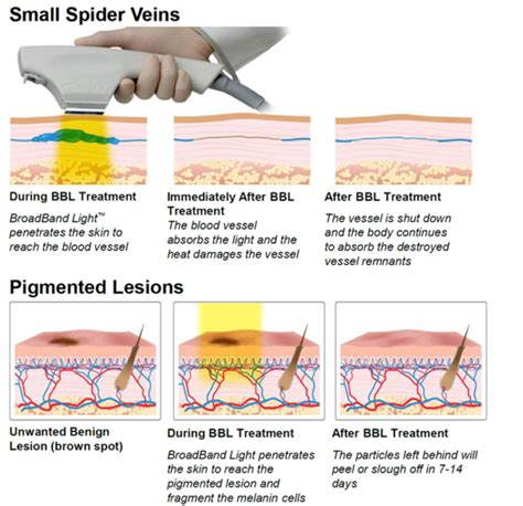 bbl laser snoqualmie  It eliminates hyperpigmentation at four times the speed and three times the power of regular BBL, allowing for quick and efficacious skin rejuvenation on the face and body