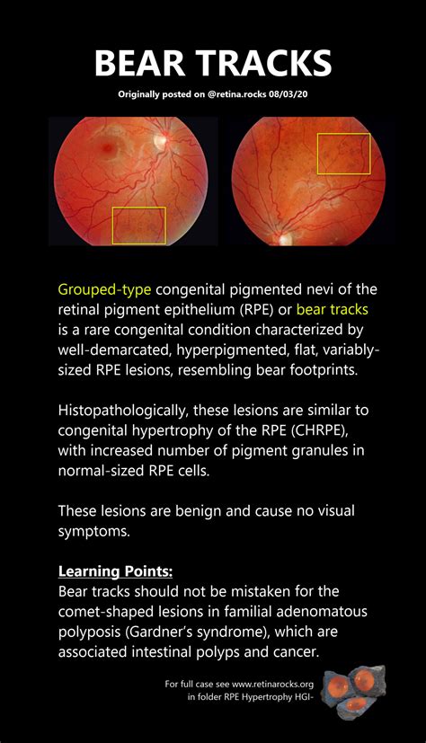 bear tracks on retina  1