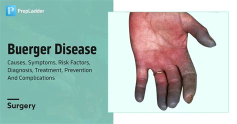 berger's disease life expectancy  In general, the entry into chronic kidney failure is slow as compared to most other glomerulonephritides – occurring over a time scale of 30 years or more (in contrast to the 5 to 15 years in other glomerulonephritides), however, in aggressive Berger's disease the time scale is within 5–10 years and often sooner