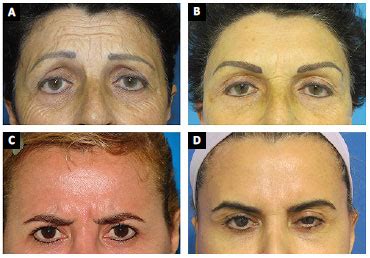 bioplastia glabela <dfn>Explicando áreas de aplicação de toxina botulínica: as áreas do terço superior da face compreendem a testa (região frontal), região entre as sobrancelhas (glabela), região no canto dos olhos (orbicular dos olhos)</dfn>