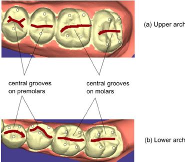 black grooves on molars <s>Just craze-y</s>