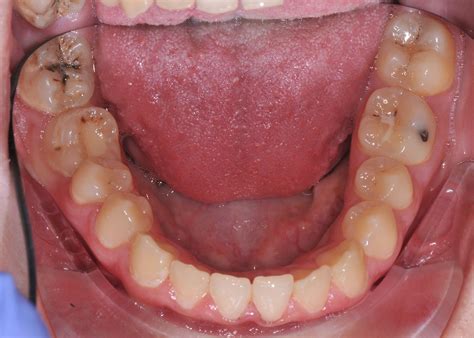 black lines in pits of molars ) Bacteria and debris build up on tooth surfaces, and the bacteria produce acids that cause decay