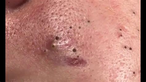 blackheads thighs  Read Next