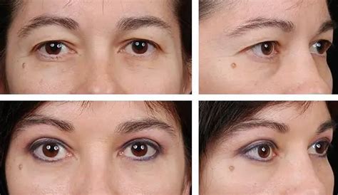 blepharoplasty omaha  Enhance your breast size or shape with a Breast Augmentation