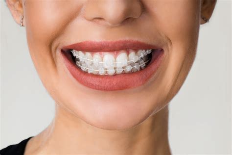 brockport clear braces  Flossing daily is essential to remove any food particles and plaque buildup