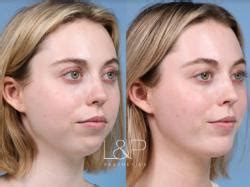 buccal fat reduction palo alto Dr