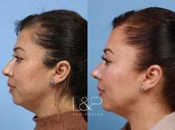 buccal fat reduction palo alto  Lower eyelids, fat transfer, FaceTite, buccal fat reduction, chin lipo & implant