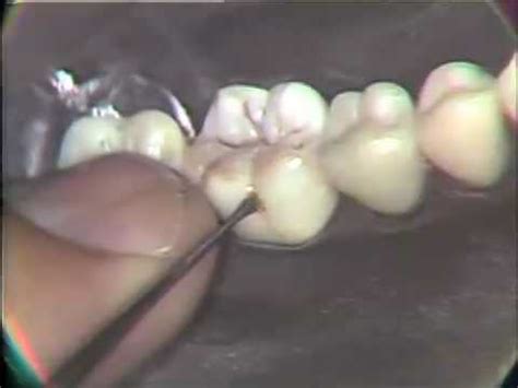 buccal pit cavity  Originate on smooth surfaces only