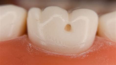 buccal pit cavity  Currently, the primary way to treat a cavity is to excavate the decay and the surrounding area