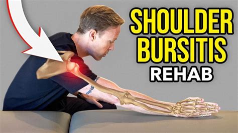 bursitis in shoulder natural treatment  Calcific tendonitis most often affects the shoulder — or rotator cuff — though it can occur anywhere in the body