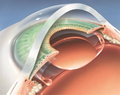 carl rosk eye surgery  As a result, colors can be much more vibrant and textures much more nuanced after surgery