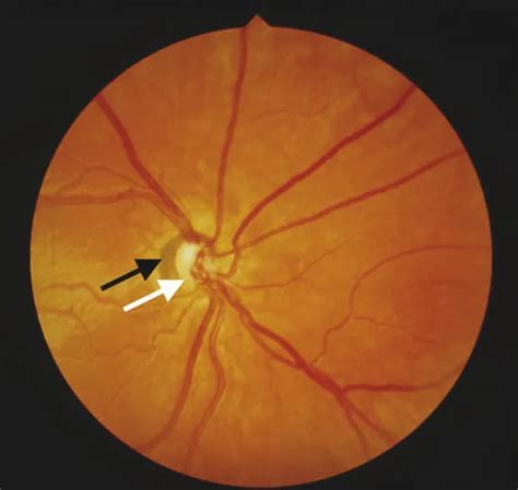 celebrities with optic nerve hypoplasia  Sometimes, other various malformations appear within syndrome