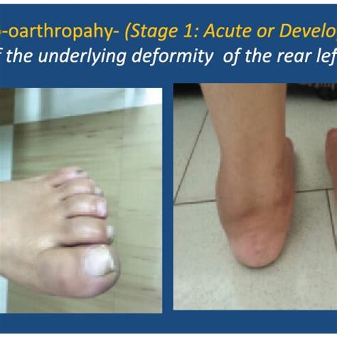 charcot left foot icd 10 39 may differ